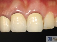 치료전후이미지