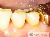 치료전후이미지