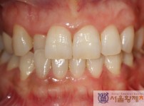 치료전후이미지