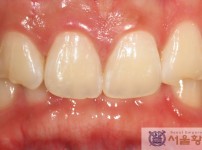 치료전후이미지