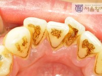 치료전후이미지