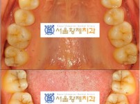 치료전후이미지