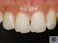 치료전후이미지