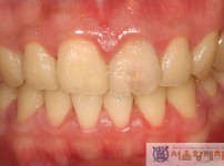 치료전후이미지